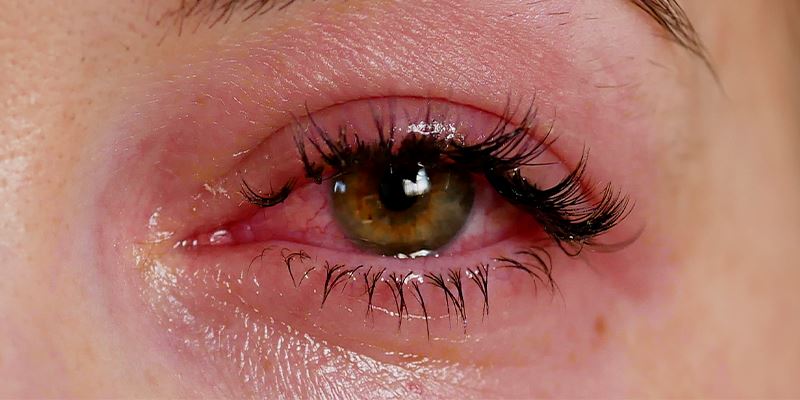 How to Combat Lash Extension Glue Allergy